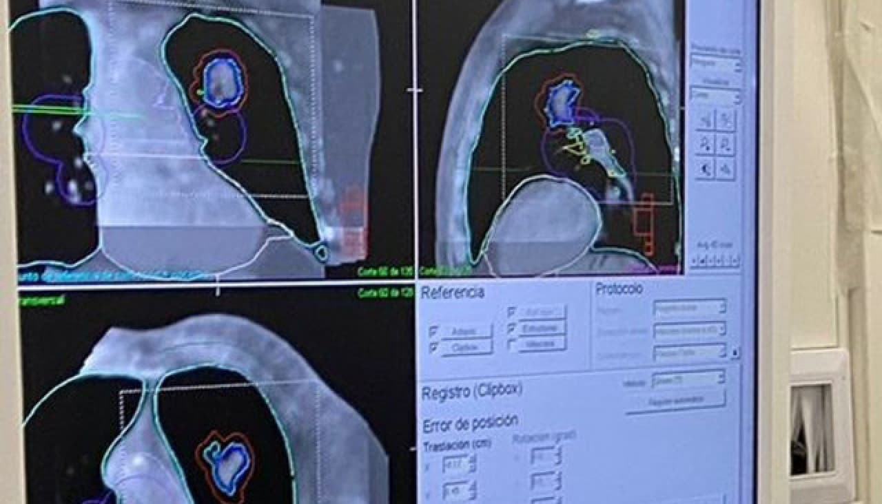 Cáncer de pulmón de células pequeñas: avances de biología e implicaciones terapéuticos