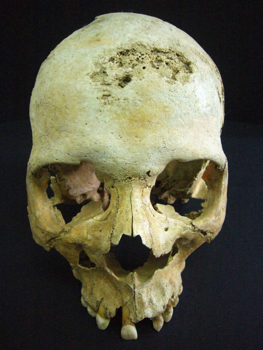 Cuando el pasado deja huella: la paleopatología y su aplicación en la identificación forense